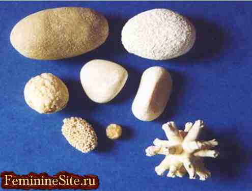Фосфатные камни в почках - причины, лечение, диета